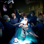 El Caule opera con una técnica mínimamente invasiva a cuatro niños con deformidad congénita del tórax